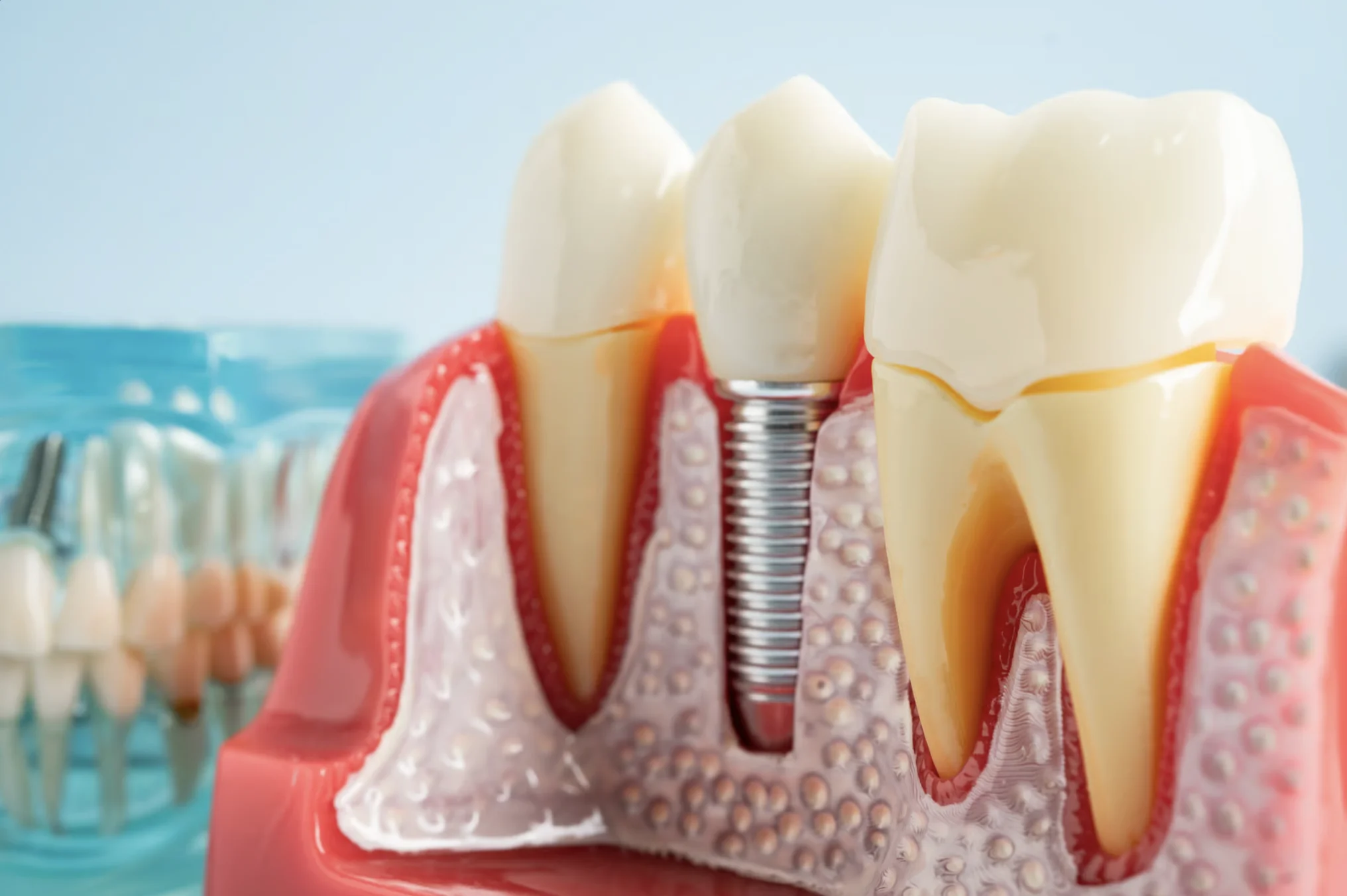 Implantes Dentales