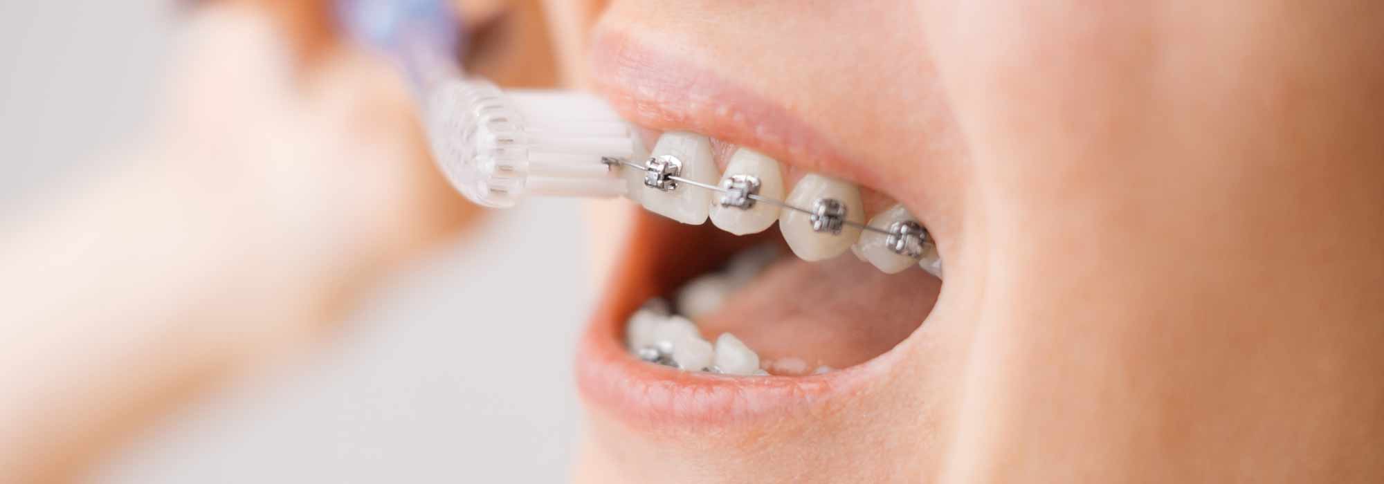 Cómo Cepillarte Con Brackets 🪥 - Portal Ortodoncia